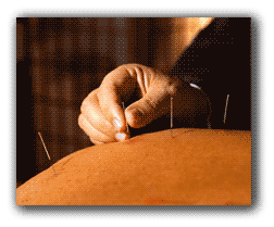 What is acupunture?